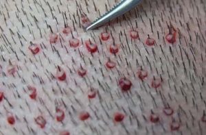 FUE tekniğini inceliyoruz