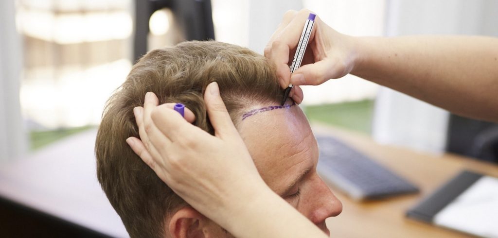 Fue Tekniği Saç Ekimi Antalya