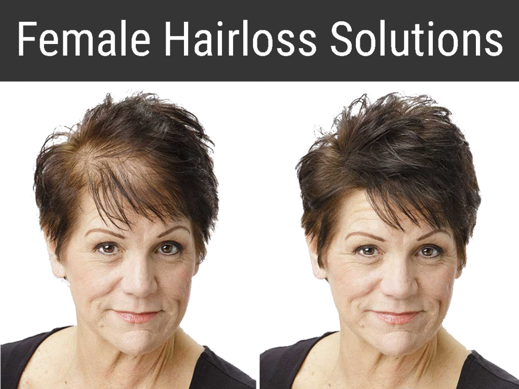 Kadınlarda Saç Ekimi