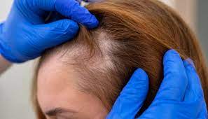 Kadınlarda saç dökülmesinin sebepleri nelerdir