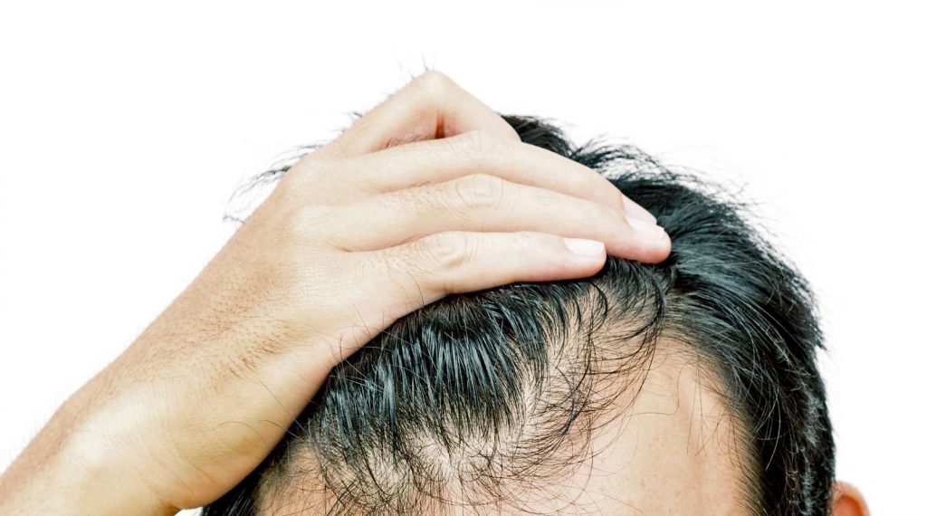 Saç Çizgisi ve Saç Ekimi Antalya