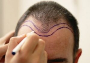 Saç ekiminde saç çizgisi ve işlevi